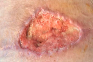 Deiscência de sutura